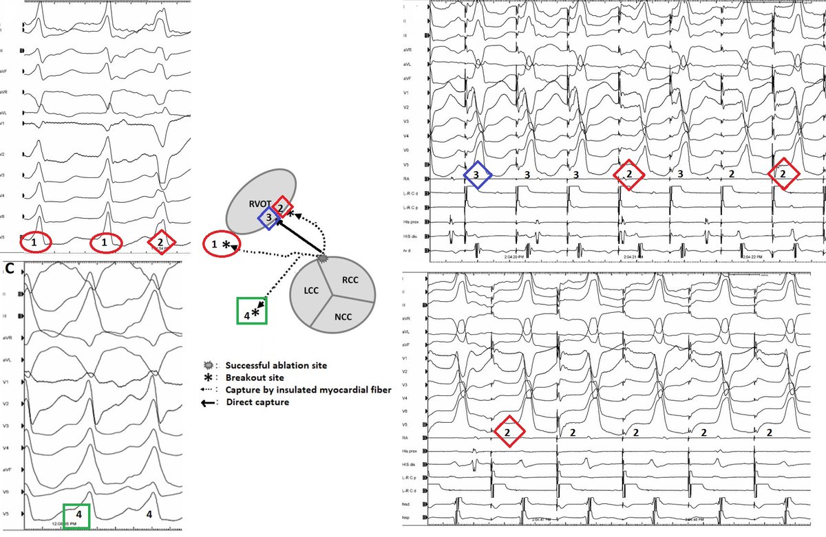 Preferential conduction with LOW and HIGH ⚡ pace mapping @cardiogenius77 @Mkara_EP @ElifhandeMD @AhmetKorkmaz07A @ozcanozeke @prof_serkan_cay @drfiratozcan @DursunAras2 @topaloglu_prof @OYousaku @ya4643su @drabdlkdruslu @NCalambur @MoussaMansour10 bit.ly/3qdcI2l @JICRM