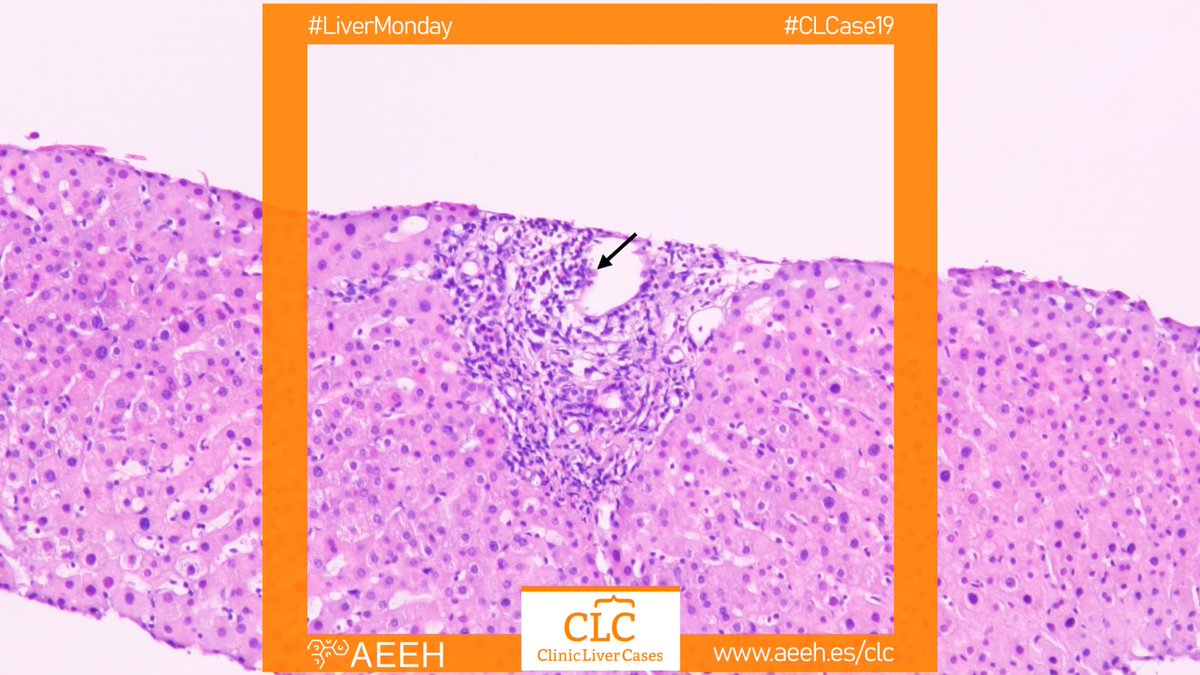 AEEHLiver's tweet photo. 👉🏻 Seguimos #CLCase19!!!
🤢 Cirrosis VHC con descompensaciones, TOH
🔥 Síndrome antifosfolípido
📈 Niveles IS ok
💊 Toma antidepresivos
🧪 AST 98, ALT 208, GGT 262, FA 236, BT 0.9
🔬 Biopsia infiltrado inflamatorio
#livertwitter #livermondays
https://t.co/K3DcIdOS8E https://t.co/F9vAvalJyr