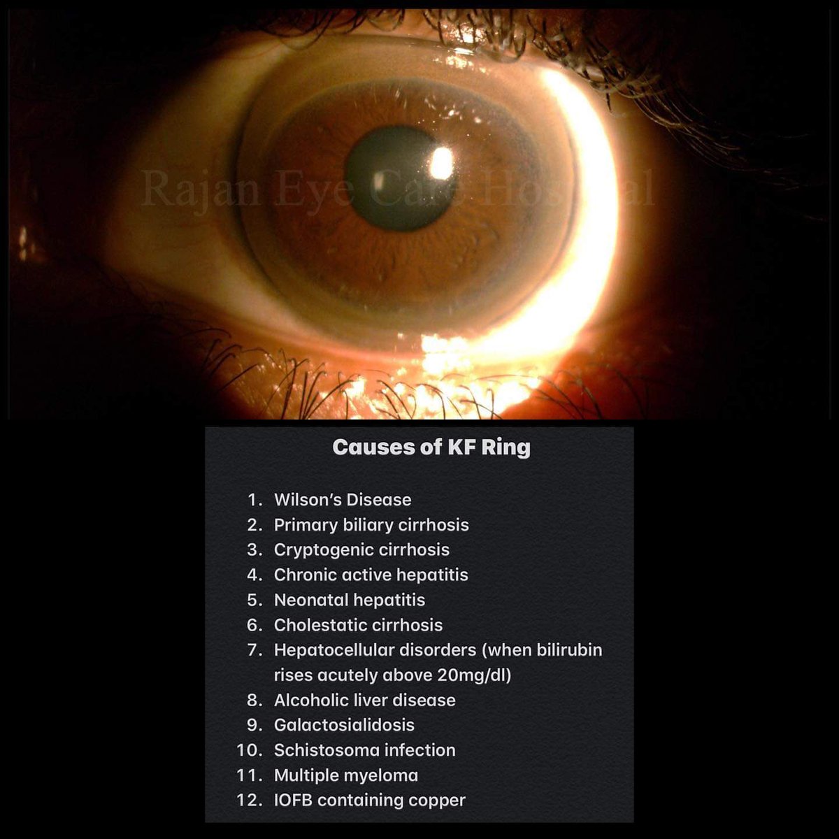 Beyond_EarthXxx's tweet photo. @AvrahamCooperMD Though 95% of patients with Willson’s and neurological involvement will present it, let’s not forget it might be present in others conditions as listed below 👇🏾👇🏾👇🏾 https://t.co/tVKrGgctAL