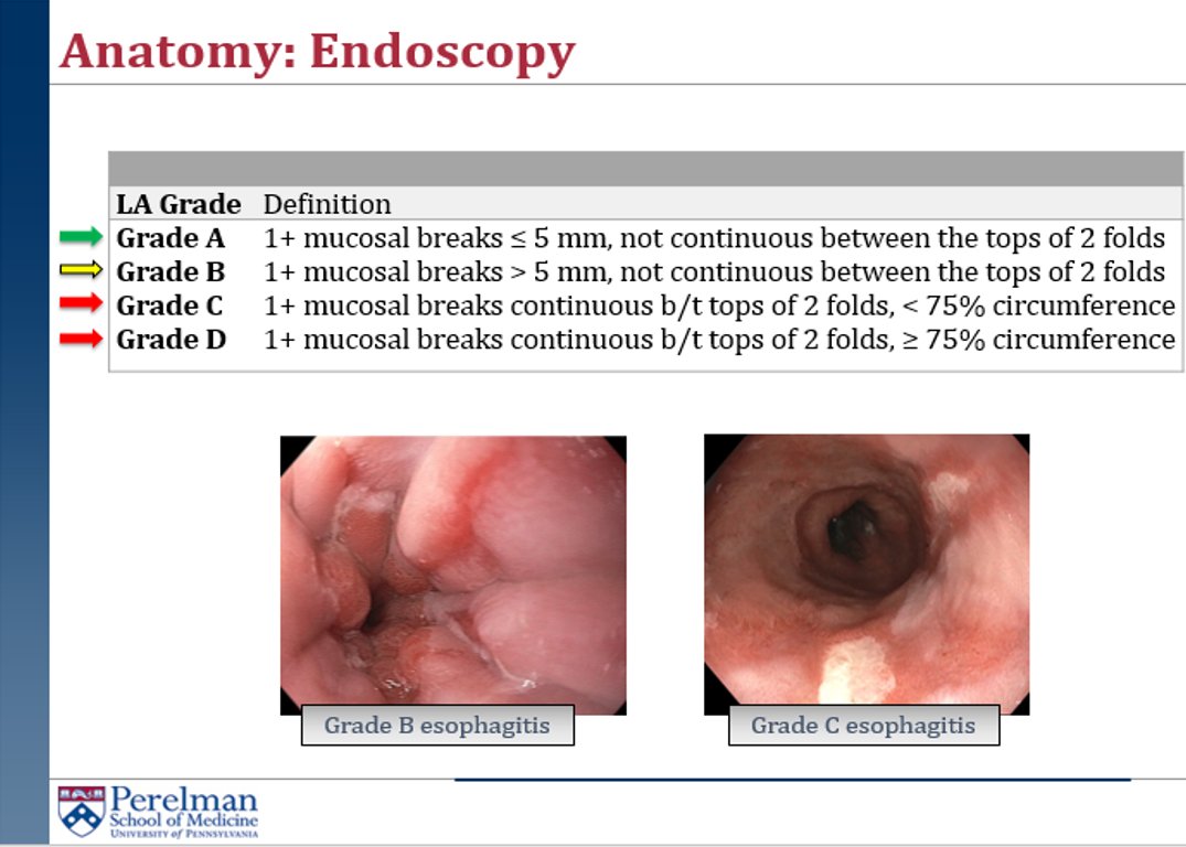 penngihep's tweet image. Closing out #PSG22 strong with @KristleLynchMD's lecture on Demystifying #GERD 
 
📢The LA Classification of esophagitis =🗝️ in assessing for objective evidence of reflux, and correlates with acid burden on #pHtesting #Refluxdisease @PennMedicine @PaGastroSoc