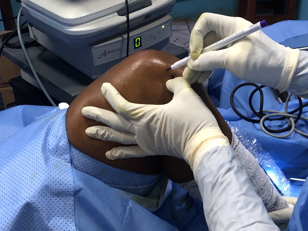 sportsurgeonng's tweet image. “Measure twice, cut once “ one of the peculiarities of minimally invasive surgery is you may not be  able to extend your incision.  It has to be accurate to the millimeter! So time spent marking your approach is never waisted #orthotips #medtwitter #orthotwitter ⁦