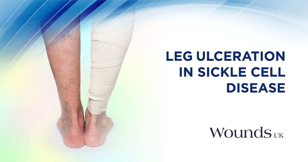 Wounds_UK's tweet photo. In this article, Trudie Young gives a comprehensive overview of sickle cell disease and its link to lower limb #ulceration: https://t.co/hr3qJA8doj #WUK #WeAreWounds https://t.co/XmhdU0c5aZ
