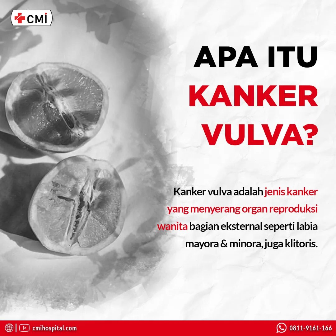 cmihospitals's tweet photo. Kanker vulva menjadi salah satu masalah kesehatan yang diderita wanita, tidak hanya bagi wanita yang sudah memasuki masa menopause atau lansia, tetapi juga bagi wanita usia muda
#gejalakanker #cirikanker #solusikanker #pengobatankanker #obatkanker #terapikanker #cmihospital https://t.co/f9UFoLaIu0