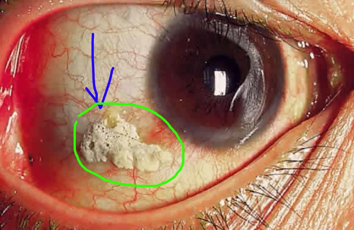 IG_pathology360's tweet photo. ✅Bitot’s spots: grey patch on bulbar conjunctiva.Pathognomonic of ✅Vit-A deficiency.Caused by squamous cell metaplasia and keratinization of the conjunctiva. #education #medicine #Vitamin #vitaminA #usmle #KeyConcepts #mbbs #md #MBBS #neetpg2023 #NEETPG2022 #plab #pathology360 https://t.co/oisLImkwJn
