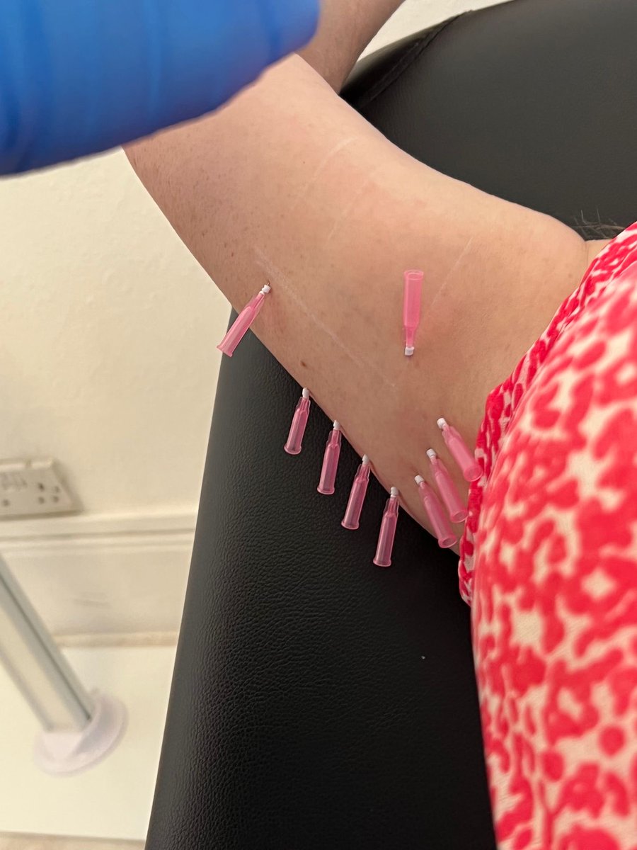 Aesthe1Complete's tweet photo. #Mono #PDO #threads for tightening skin underarms get the #collagen back to skin. Will see result in 2 months time https://t.co/PDa32xDWo1