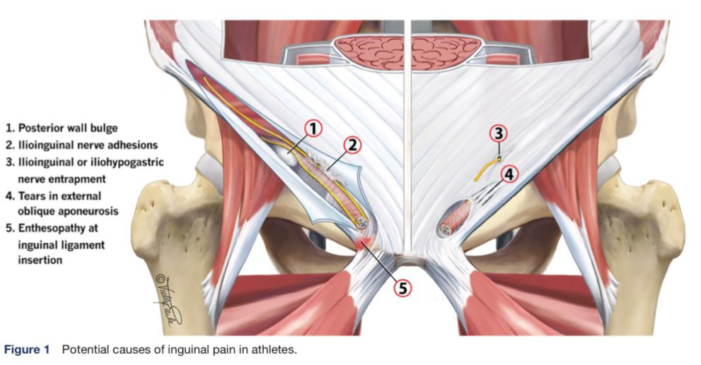BMJOpenSEM's tweet photo. 🆕Editorial
“Inguinal-related #groin #pain in #athletes: a pathological potpourri”
by @zarkov_d, @aserner, @WillemHeijboer, @adamweirsports

🗣“… we need a broad approach &amp; embrace that there is uncertainty”
 
Open access:
https://t.co/ziA4w4bguE

#WeAreBOSEM
#UnderTheSpotlight https://t.co/pBvFYcdlRj