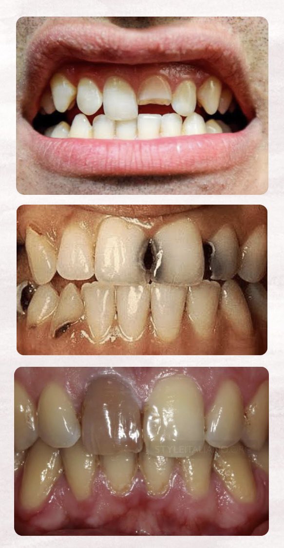 Hai haiiii Bandungg! 🙌 Bagi warga bandung yang gigi depannya patah hampir setengah gigi, berlubang besar, juga berubah warna, dan pernah sakit banget atau bahkan sekarang lagi sakit dan ingin di rawat koas kedokteran gigi boleh banget langsung DM!!! 👍😃 #koasgigi