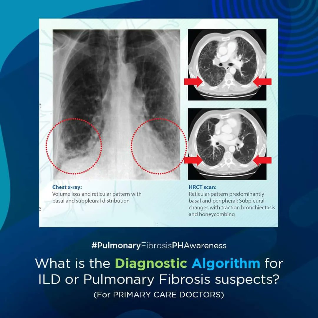 ildph2023's tweet photo. Diagnostic Approach of Pulmonary Fibrosis for Primary Care Physicians
#pccp #pccpadvocacy #pccplungmonth #pulmonaryfibrosisphawareness #hingakalungs https://t.co/c7Fq9aJPCq