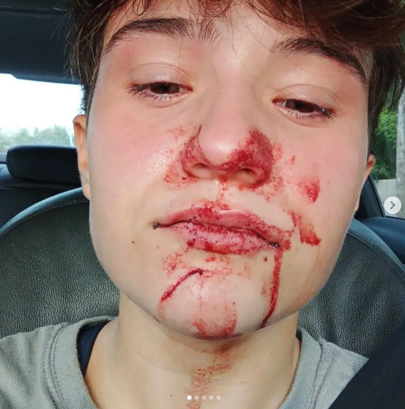 CarlaAntonelli's tweet photo. El horror del sin parar, Edurne, de 15 años, brutal agresión en San Vicente del Raspeig, cuando estaba con su novia, diez niños y adolescentes la dejaron así al grito "maricona" "transexual" "transformer" solo por su forma de vestir y pelo corto, como señala. Que doloroso todo 😢 https://t.co/KRXoLuUNY0
