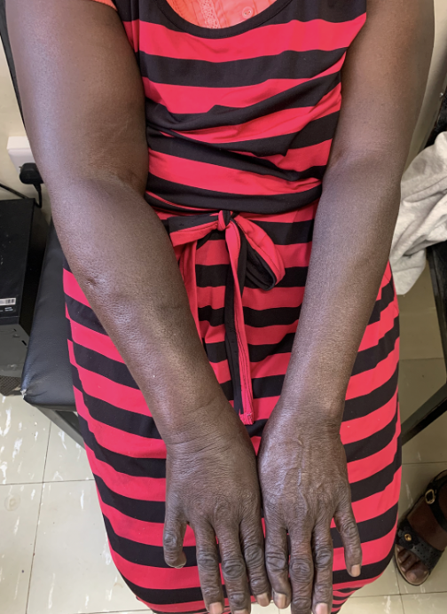 ManualofSurgery's tweet photo. New chapter- Axillary Dissection by the veteran surgeon and mentor to many- Peter Bird. 
@VUMCGlobalSurg
@cosecsa
@rcsi_cosecsa
#SoMe4Surgery #GlobalSurgery
https://t.co/ly5xMnsdIZ https://t.co/OeMzDyX2a4