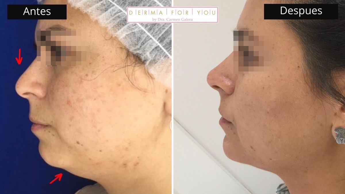 Dermaforyou's tweet photo. Hemos utilizado uno solo vial de #volift xa la punta nasal q está + elevada ¿Veís la diferencia?
+ 1 vial de volux para mejorar la zona del mentón!
Ahora tiene la cara + ovalada, menos redonda y en el perfil el mentón se ve más armónico.
https://t.co/ZJFhFJLwjd https://t.co/hlzve5nlx3