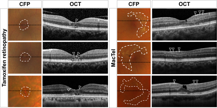 AAOjournal's tweet photo. Macular Telangiectasia type 2 &amp; Tamoxifen-Retinopathy share a highly similar retinal phenotype. Multimodal imaging may help distinguishing between these 2 entities. An affection of Müller cells in both diseases may explain observed phenotypic similarities. https://t.co/5qNFUlpDUF https://t.co/zypLVQg55i