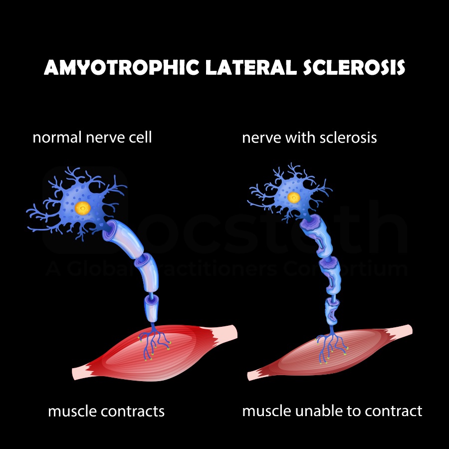 Docsteth1's tweet photo. 90% of cases occurs WITHOUT a family history!
To know more about Amyotrophic Lateral Sclerosis click on the link
🔗https://t.co/5no8G4wpoC
#AmyotrophicLateralSclerosis #ALS #Neurology #Brain #MBBS #Doctors #Docsteth #DocstethPost #MedTwitter https://t.co/WGbHxxkXDM