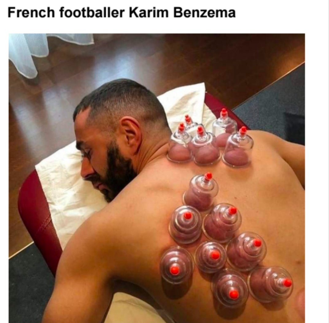 new_cupping's tweet photo. Why athletes choose to use this alternative therapy option https://t.co/nYAprNy2YQ