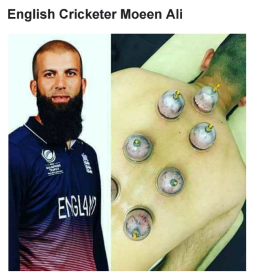 new_cupping's tweet photo. Why athletes choose to use this alternative therapy option https://t.co/nYAprNy2YQ