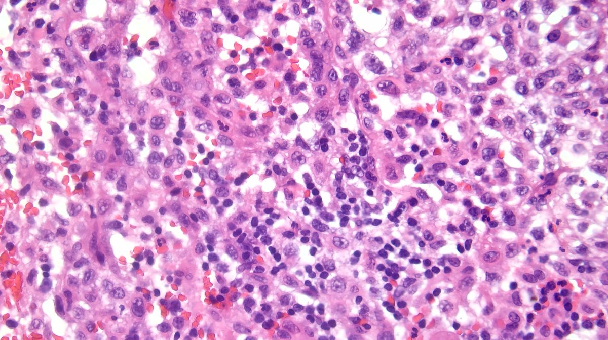 40's Female with a large pelvic lymph node. History of Asthma, cervical lymphadenopathy and resection of a "spine mass" 6 years ago. Nice example of this rare entity- how would you work this up?

#PathTwitter #surgpath #hemepath #BSTPath