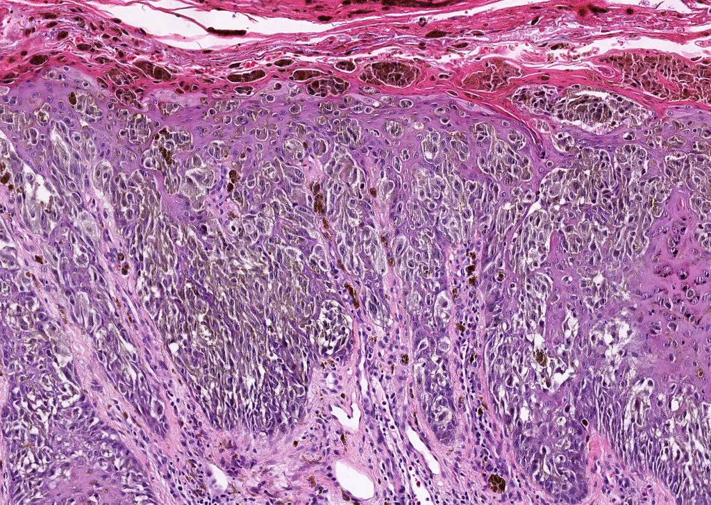 Can you make diagnosis from one pic, or is it #TooCloseToDiagnose? WSI digital slide: kikoxp.com/posts/10777. Answer &amp; explanation: kikoxp.com/posts/10778. Video: kikoxp.com/posts/3764. #pathology #pathologists #pathTwitter #dermpath #dermatology #dermatologia #dermtwitter