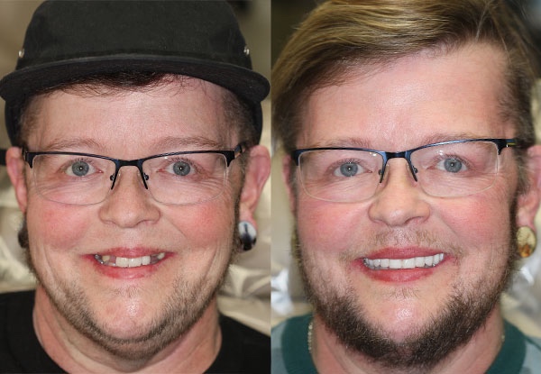 Check out Bret’s life changing Lampee Rejuvenation! His new upper implant dentures are secured with four permanent anchors and feel like a solid, sturdy set of healthy teeth. Bret couldn’t be more confident in his new smile! 😃

📱  Call 503-683-8787
💻  DrLampee.com