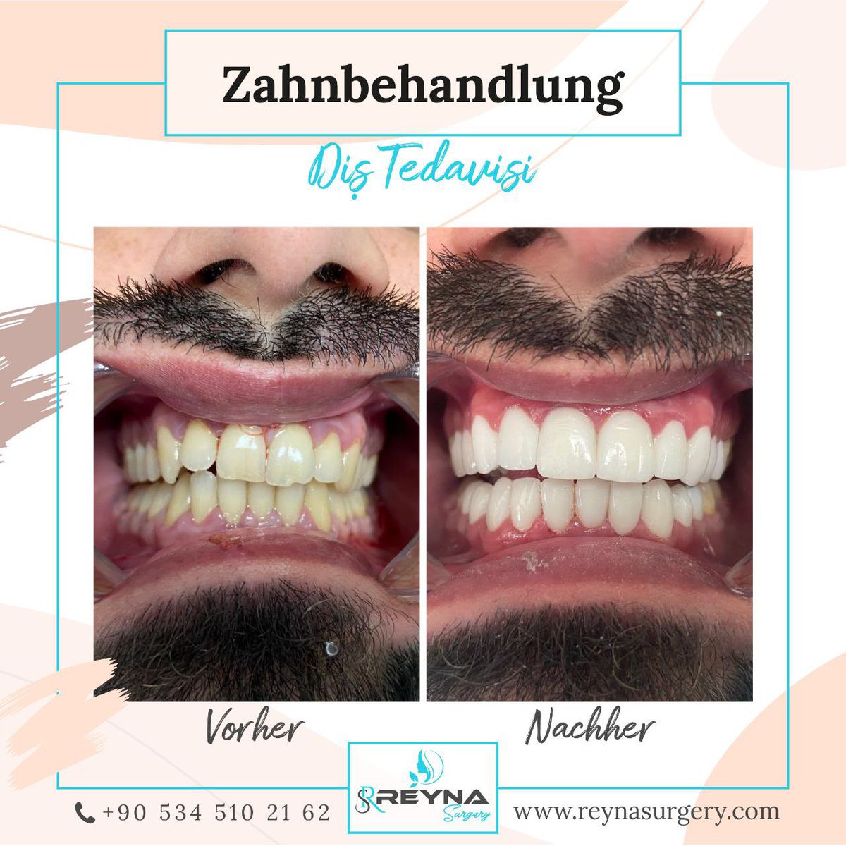 reyna_surgery's tweet photo. Möchtest du auch strahlende Zähne bekommen? Sende güzel dişlere sahip olmak istiyor musun?☘️

📞 +90 534 510 2162

#dental #dentist #teeth #zahnmedizin #krone #implant #implants #bleaching #zahnreinigung #whiteteeth
#zahnarzt #pflege #clean #reynasurgery #İzmir https://t.co/LKhbPtoV8I