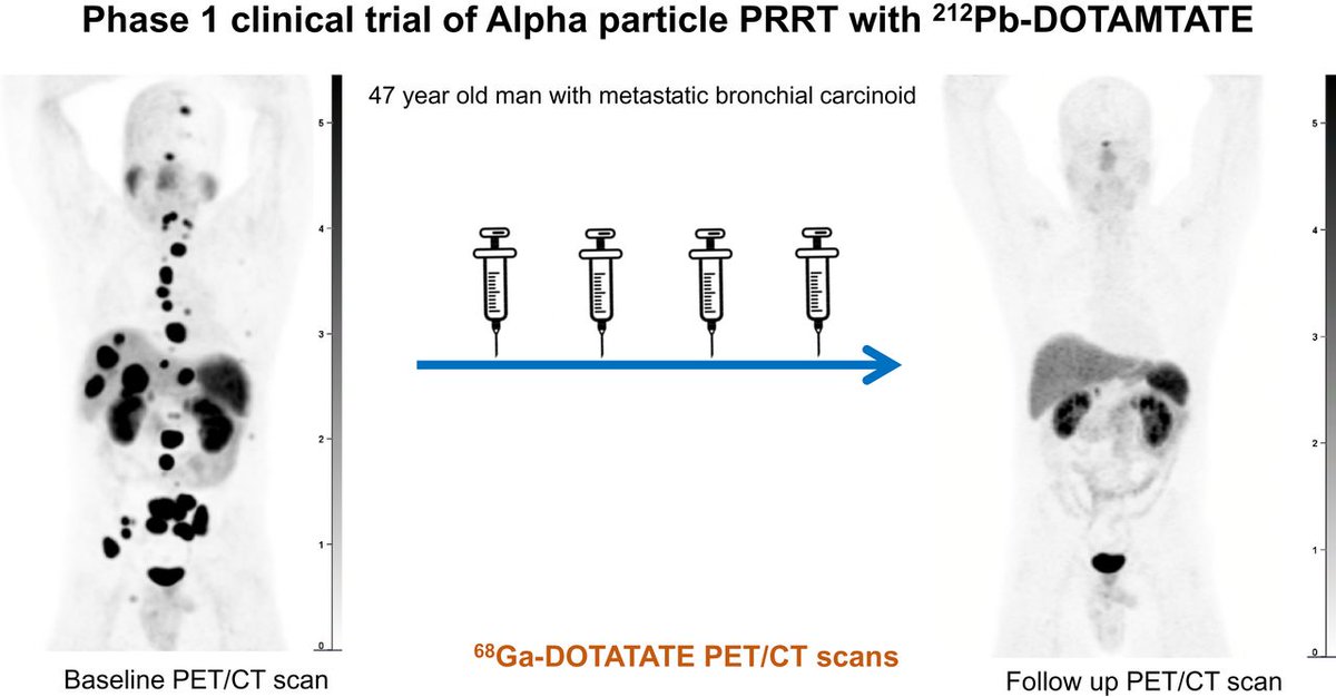 JournalofNucMed's tweet photo. Targeted alpha therapy with ²¹²Pb-DOTAMTATE in #NETcancer patients has shown great potential, exceeding the standard-of-care treatments currently available; Phase II study coming soon! https://t.co/GjxcH7yjcA @delpassand 

#Theranostics = #PrecisionOncology https://t.co/5hiGgmdNuC
