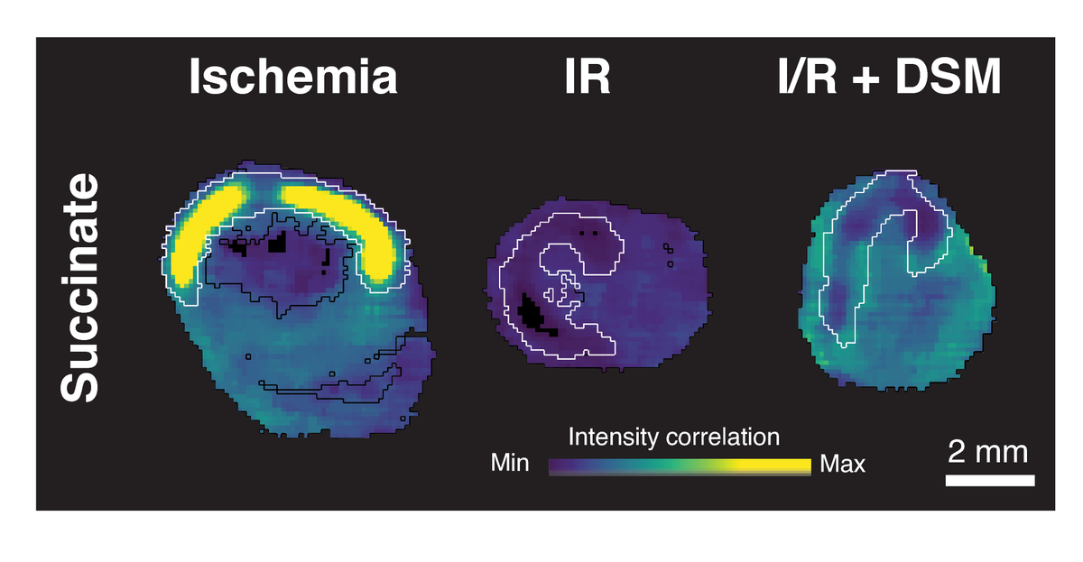 Prag &amp; colleagues demonstrate that #malonate selectively enters at risk tissue during #IR to block #SDH &amp; cardiac damage. Learn more at  ahajrnls.org/3REYa6c     
<a href="/hiranprag/">Hiran A. Prag</a> <a href="/thomaskrieglab/">Krieg Lab</a> <a href="/dunjaaks/">Dunja Aksentijevic Ricciarelli</a> <a href="/astrazenecaUK/">AstraZenecaUK</a> <a href="/DrJReinhold/">Johannes Reinhold</a> <a href="/cambridgecardio/">CambridgeCardio</a> @MRCMBU