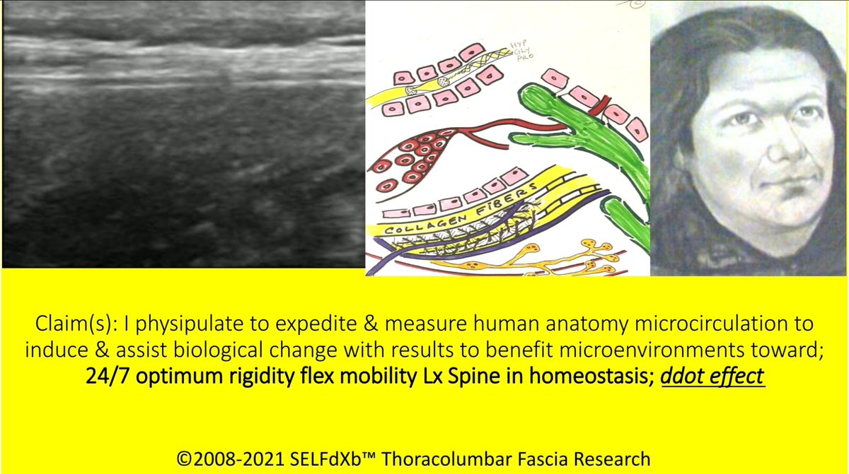 ExtremeHandless's tweet photo. @SpineApocalypse @TheFasciaHub @dXbModality @SELFdXb These are images of my #TLF #ThoracolumbarFascia
I paid the price to learn, train, heal from a devastating lumber injury. To avoid #Spine fusion surgery & #failedspinesurgery. To skillfully ipulate anatomy and #physipulate my TLF toward 24/7 spine health in homeostasis.
Success https://t.co/ISuNMKGOms