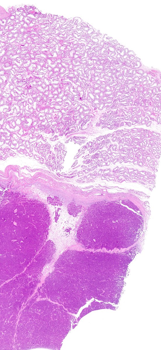 M/35y, orchifuniculectomy, spermatocytic tumor.
Gross, low power magnification.
🧵1/3
#GUPath  #Testis  #spermatocytictumor  #Pathoutpic