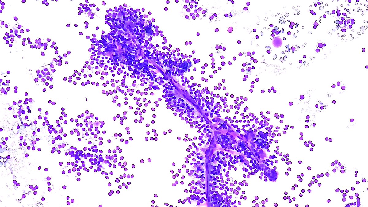 Yalwelaie's tweet photo. Solid pseudopapillary neoplasm (SPN) of the pancreas on direct cytologic smears obtained during on-site evaluation. Neoplastic cells are seen clinging to the branching delicate capillaries. #CytoPath https://t.co/dkHEFj9SBH