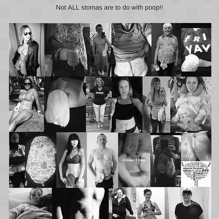 vikkipalmer68's tweet photo. Day12 #urologyawarenessmonth The Urostomy is still very much the forgotten stoma. We trying to raise awareness we need more patient advocate In urology and in the stoma community with urostomys I was  incredibly proud and excited to be part of the campaign. By @rocking2stomas https://t.co/4BXkPQbd0f