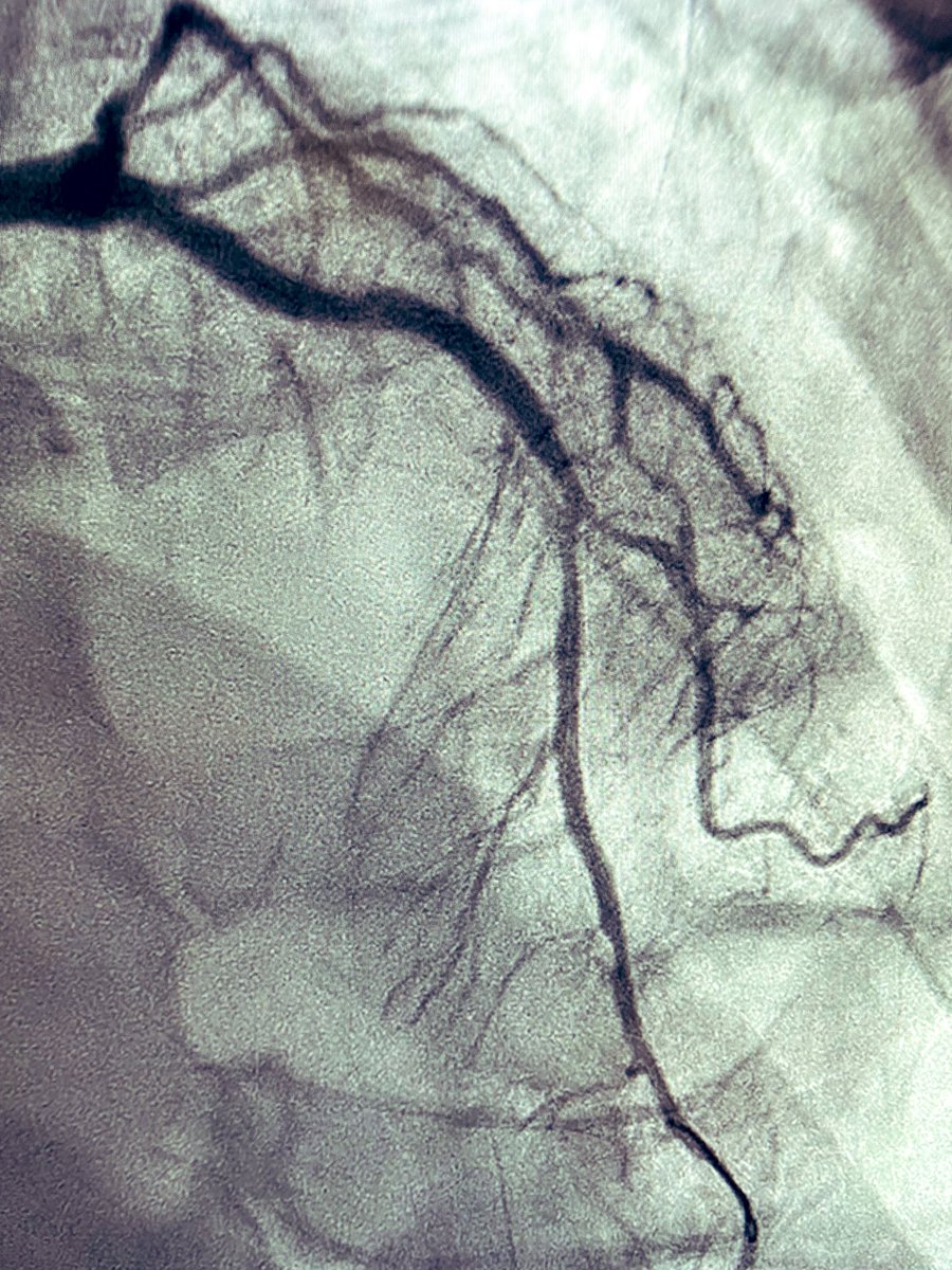 agtruesdell's tweet photo. #RotaTripsy: heavily calcified LAD. IVUS wouldn’t cross. Pilot channel with Rota. Then IVUS. Then IVL via Guidezilla for more complete calcium modification. Then IVUS-guided DES… https://t.co/aOA86OjeOs