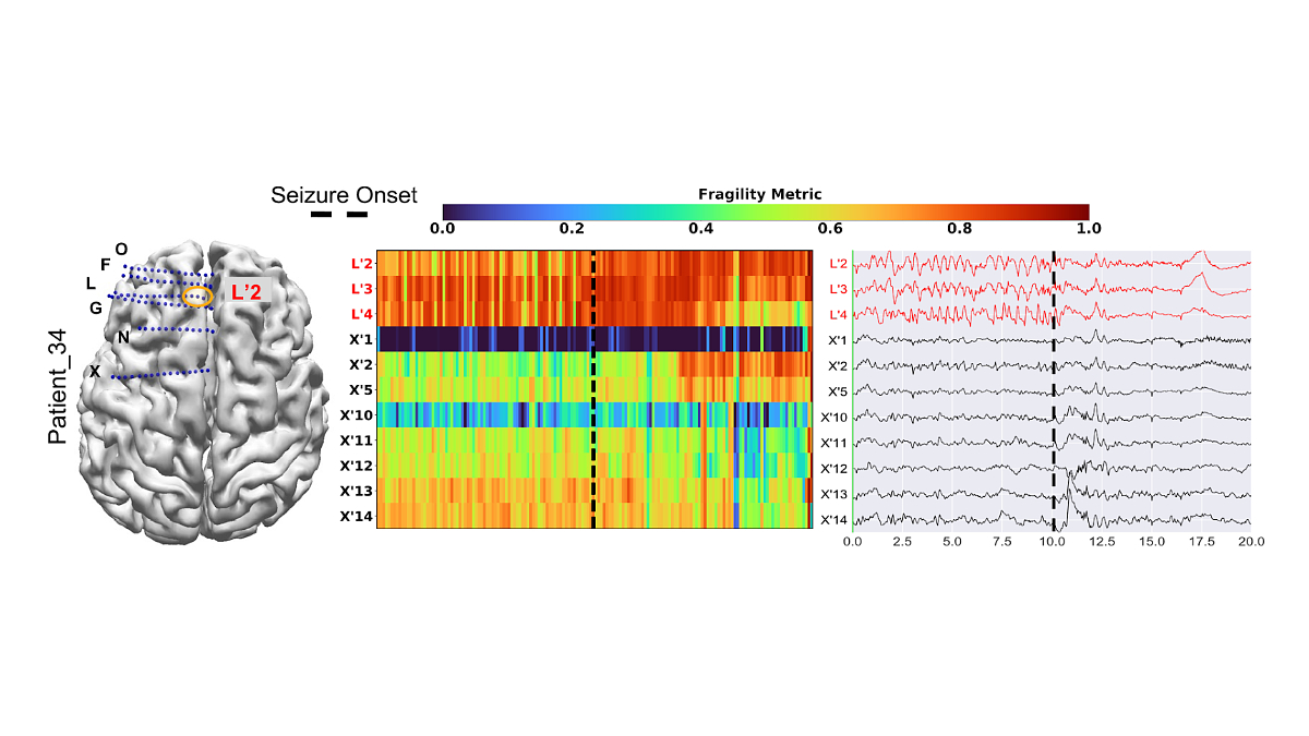 IEEEBrain's tweet photo. Did you catch this featured article from the @IEEEBrain #BrainInsight newsletter? If not, it's worth a read. "Neural Fragility of #EEG May Help Localize the Seizure Onset Zone" details a new marker able to correctly predict 76% of surgical failures: https://t.co/P2EQMDhty3 #brain https://t.co/Sn42bJGzPj