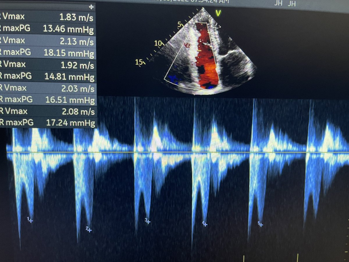 BhaskarArora_MD's tweet photo. CW Doppler signal through the TV in apical window. Why is the signal Bifid? 
Clue: see ECG attached

@ASE360 #ACCFIT https://t.co/SY0tN6Ef4d