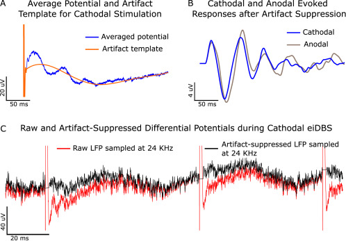 umnneurosurgery's tweet photo. Controlling pallidal oscillations in real-time in Parkinson's disease using evoked interference deep brain stimulation: Proof of concept in the human | Coauthors include faculty members Drs. Michael C. Park, David Darrow, and Robert McGovern | https://t.co/aIZCHZJm59 https://t.co/LIHwyPa7va