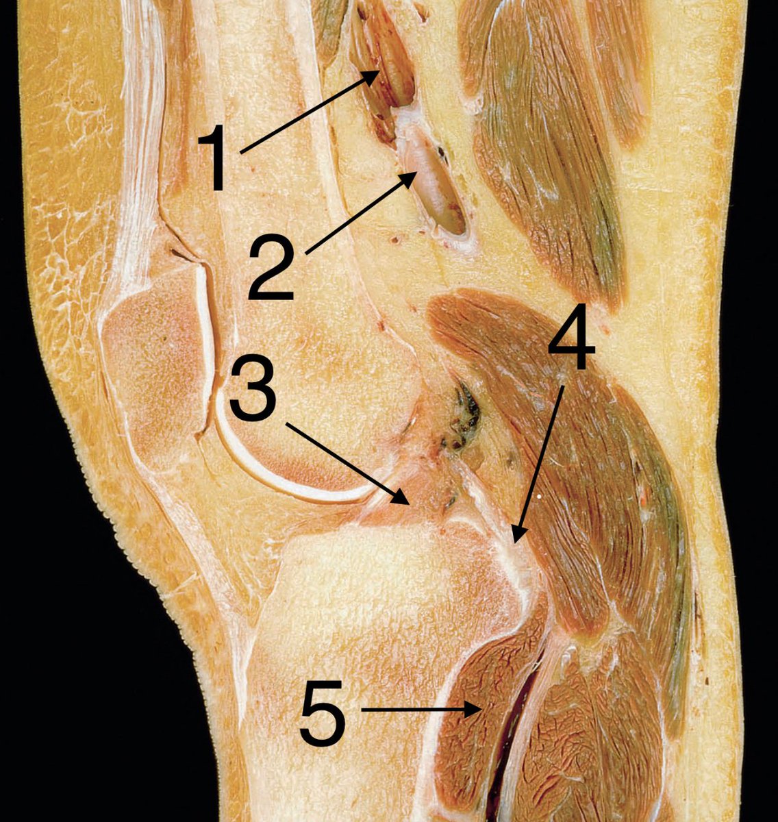 PPT - ``LESIONES MAS FRECUENTES PROVOCADAS POR MOVIENTOS DE LA RODILLA´´  PowerPoint Presentation - ID:2004539, image size:1136x1200