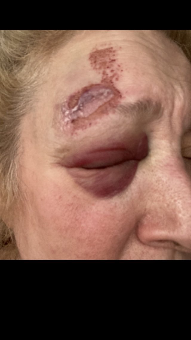 SAJonesEsq's tweet photo. #Cai darling, I know all the secrets - #greenconcealer etc! Pls email/#DM where I can send #emergency #Unleashed #Livid #booktour #makeupset! REST TODAY! #Proprioception #ADS #ALS #vertigo #equilibrium Come on #cerebellum! (No, we don’t have #littlebrain(s) #16thCentury #Latin!) https://t.co/Q5evRGB1kx