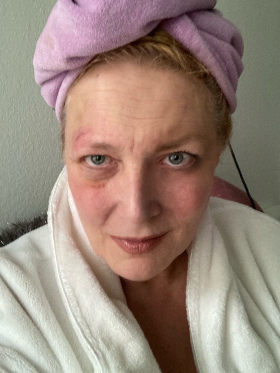 SAJonesEsq's tweet photo. #Cai darling, I know all the secrets - #greenconcealer etc! Pls email/#DM where I can send #emergency #Unleashed #Livid #booktour #makeupset! REST TODAY! #Proprioception #ADS #ALS #vertigo #equilibrium Come on #cerebellum! (No, we don’t have #littlebrain(s) #16thCentury #Latin!) https://t.co/Q5evRGB1kx