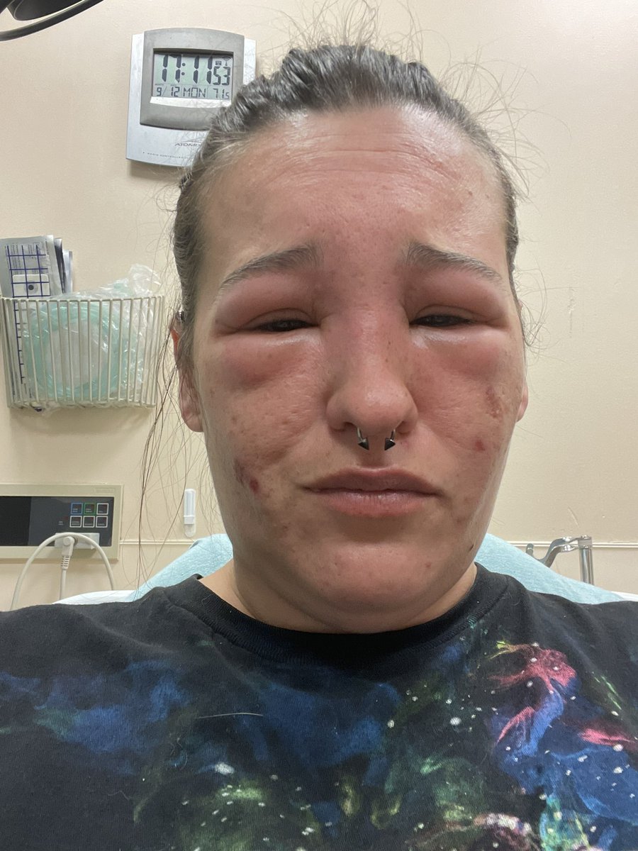 _Halawia's tweet photo. Turns out I have a deadly bee allergy 😫 https://t.co/ob4gsSHUPP