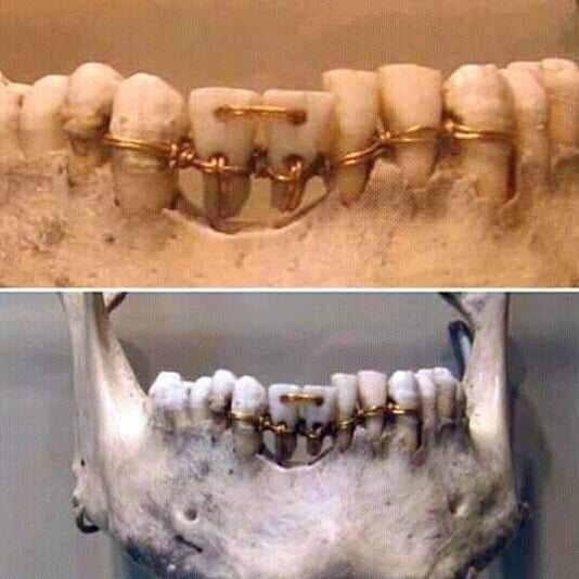 asIiceofhistory's tweet photo. Dental work found on a 4,000- year old mummy in ancient Egypt https://t.co/d48yU8BTLl