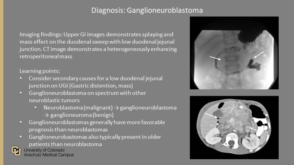 CU Pediatric Radiology (@pedsradscolo) on Twitter photo <a href="/PedsRadsColo/">CU Pediatric Radiology</a> Weekly #QualityRounds:
Young child with weight loss and early satiety
#ImagingOurFuture #PedsRad #MedEd #RadRes #FOAMrad #FOAMed #GoodCall #PeerLearning #RadTwitter
<a href="/COpediatricEM/">🏔COpediatricEM🚑</a> <a href="/SocPedRad/">The Society for Pediatric Radiology</a> <a href="/CURadiology/">CU Radiology</a> <a href="/curadresidents/">CU Radiology Residents</a> <a href="/PedsRadsColo/">CU Pediatric Radiology</a> Weekly #QualityRounds:
Young child with weight loss and early satiety
#ImagingOurFuture #PedsRad #MedEd #RadRes #FOAMrad #FOAMed #GoodCall #PeerLearning #RadTwitter
<a href="/COpediatricEM/">🏔COpediatricEM🚑</a> <a href="/SocPedRad/">The Society for Pediatric Radiology</a> <a href="/CURadiology/">CU Radiology</a> <a href="/curadresidents/">CU Radiology Residents</a>