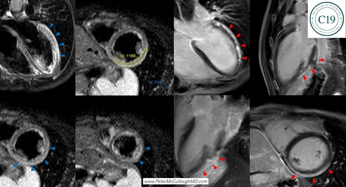 P_McCulloughMD's tweet photo. Cardiac MRI is a critical technology in the diagnosis of \/ induced myocarditis.  Peak occurrence is a few days after the second one.  The arrows point to large areas of late gadolinium enhancement which represents inflammation and later on scar leading to sudden cardiac death. https://t.co/bv87uqz0ts