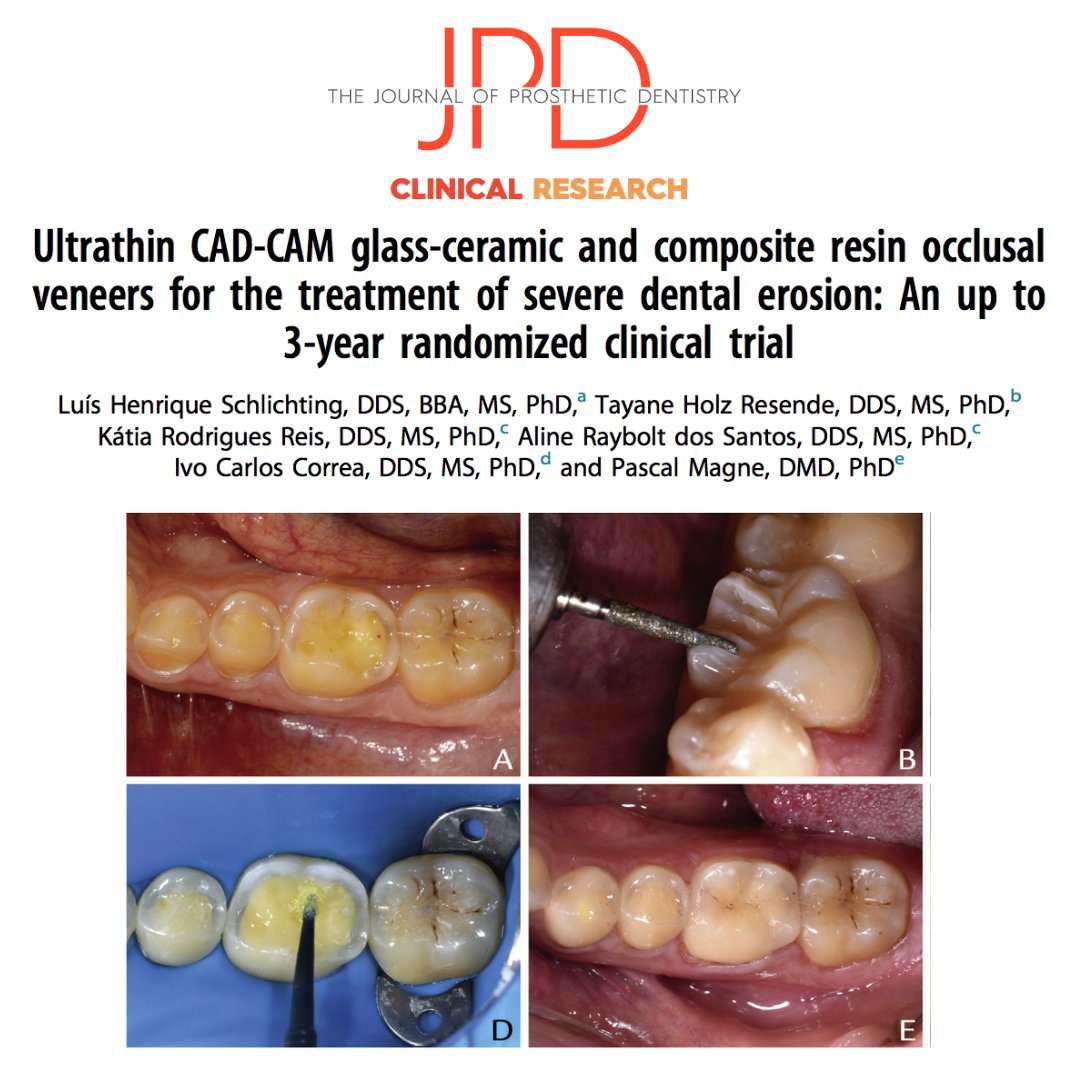 JPDentistry's tweet photo. Check out the latest issue of #theJPD! We highlight this #randomizedclinicaltrial that evaluates the clinical outcomes of #CADCAM #lithiumdisilicate vs. #compositeresin ultrathin #veneers restoring the occlusal surfaces of #worndentition. Learn more: https://t.co/eONwdjSokL https://t.co/uhuLA2256a