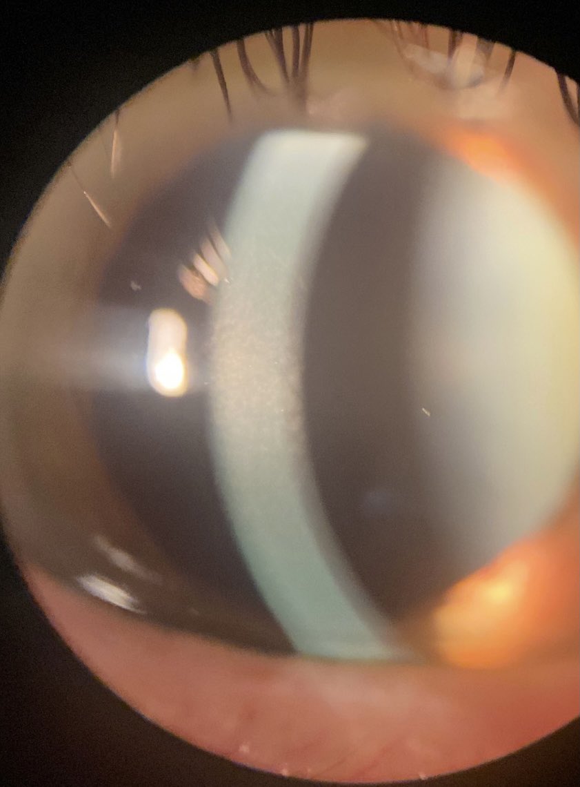 thecorneaMD's tweet photo. Central cloudy dystrophy of Francois
- usually not visually significant

#cornea #dystrophy https://t.co/eBmhNT8xYs