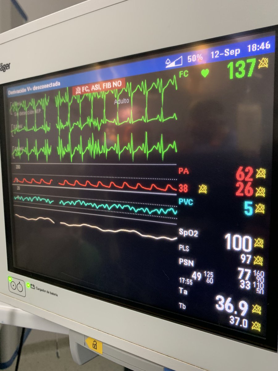 RUTWOLF's tweet photo. Paciente 17 días, 3.4 kgrs. Diagnóstico de Cardiopatía Compleja, Hipoplasia de Arco Aórtico, CIV. PCA. #AnestesiaCardiacaPediatrica
#CirugiaCardiacaPediatrica
#CirculacionExtraCorporea
#Hipotermia #Calentamiento
#PinzamientoAortico #RitmoSinusal
#Aminas #Heparina #Protamina https://t.co/L7nk6BYjYa
