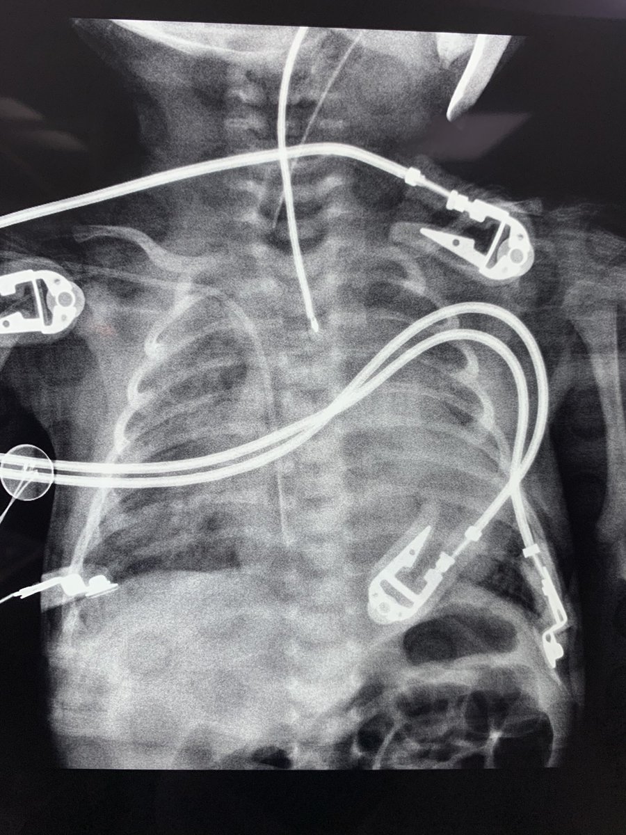 RUTWOLF's tweet photo. Paciente 17 días, 3.4 kgrs. Diagnóstico de Cardiopatía Compleja, Hipoplasia de Arco Aórtico, CIV. PCA. #AnestesiaCardiacaPediatrica
#CirugiaCardiacaPediatrica
#CirculacionExtraCorporea
#Hipotermia #Calentamiento
#PinzamientoAortico #RitmoSinusal
#Aminas #Heparina #Protamina https://t.co/L7nk6BYjYa