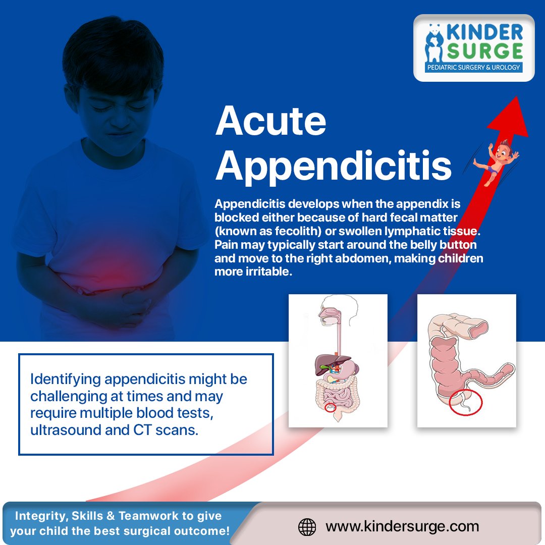 kindersurge's tweet photo. Surgical removal of the appendix using laparoscopy is the standard of care for acute appendicitis

#Kindersurge #appendix #tinyworm #intestines #acuteappendicitis #nausea #vomiting #laparoscopy 
@Arka1dering @doc_ved https://t.co/OulFddJIQL