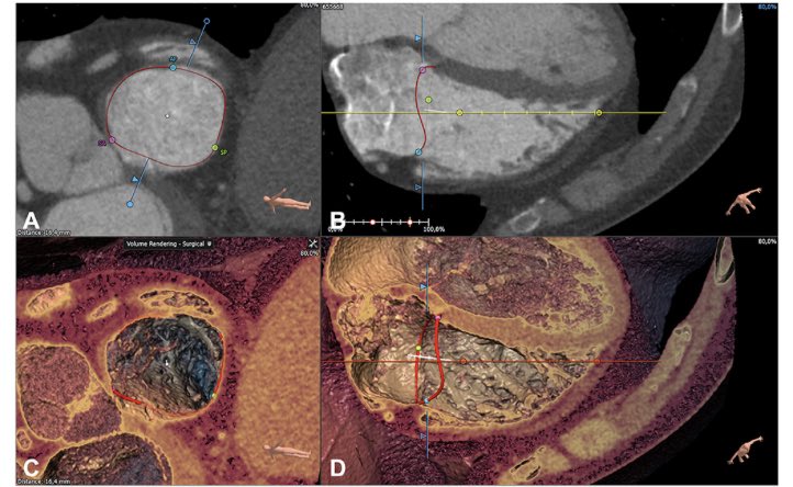 Denisa Muraru (@denisamuraru) on Twitter photo Reference values of tricuspid annulus by #3DEcho dedicated software: validation with #YesCCT, comparison with 2D echo and reproducibility
#PCRTricuspid <a href="/m_taramasso/">Maurizio taramasso</a> <a href="/drmaisano/">francesco maisano</a> <a href="/hahn_rt/">RTHahnMD</a>
frontiersin.org/articles/10.33… Reference values of tricuspid annulus by #3DEcho dedicated software: validation with #YesCCT, comparison with 2D echo and reproducibility
#PCRTricuspid <a href="/m_taramasso/">Maurizio taramasso</a> <a href="/drmaisano/">francesco maisano</a> <a href="/hahn_rt/">RTHahnMD</a>
frontiersin.org/articles/10.33…