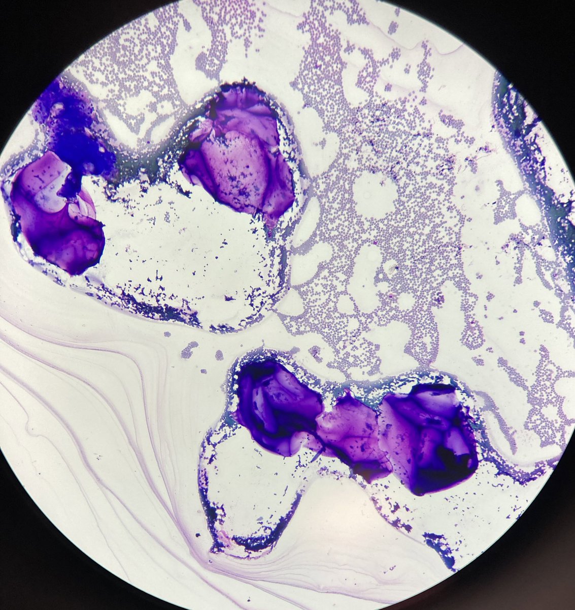 AlainCagaanan's tweet photo. FNA of a parotid mass 🤔 #cytopath #entpath #pathology @ https://t.co/k1U075Undk