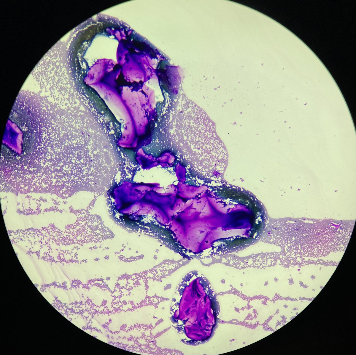 AlainCagaanan's tweet photo. FNA of a parotid mass 🤔 #cytopath #entpath #pathology @ https://t.co/k1U075Undk