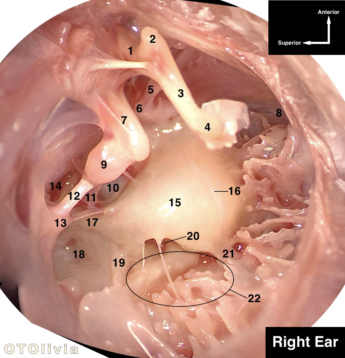 I bet everyone is an endoscopic ear wizard after the @endoear meeting! I saw a lot of endoscopic talk at ANS and #OTOMTG22 
I think it’s time for a quiz: