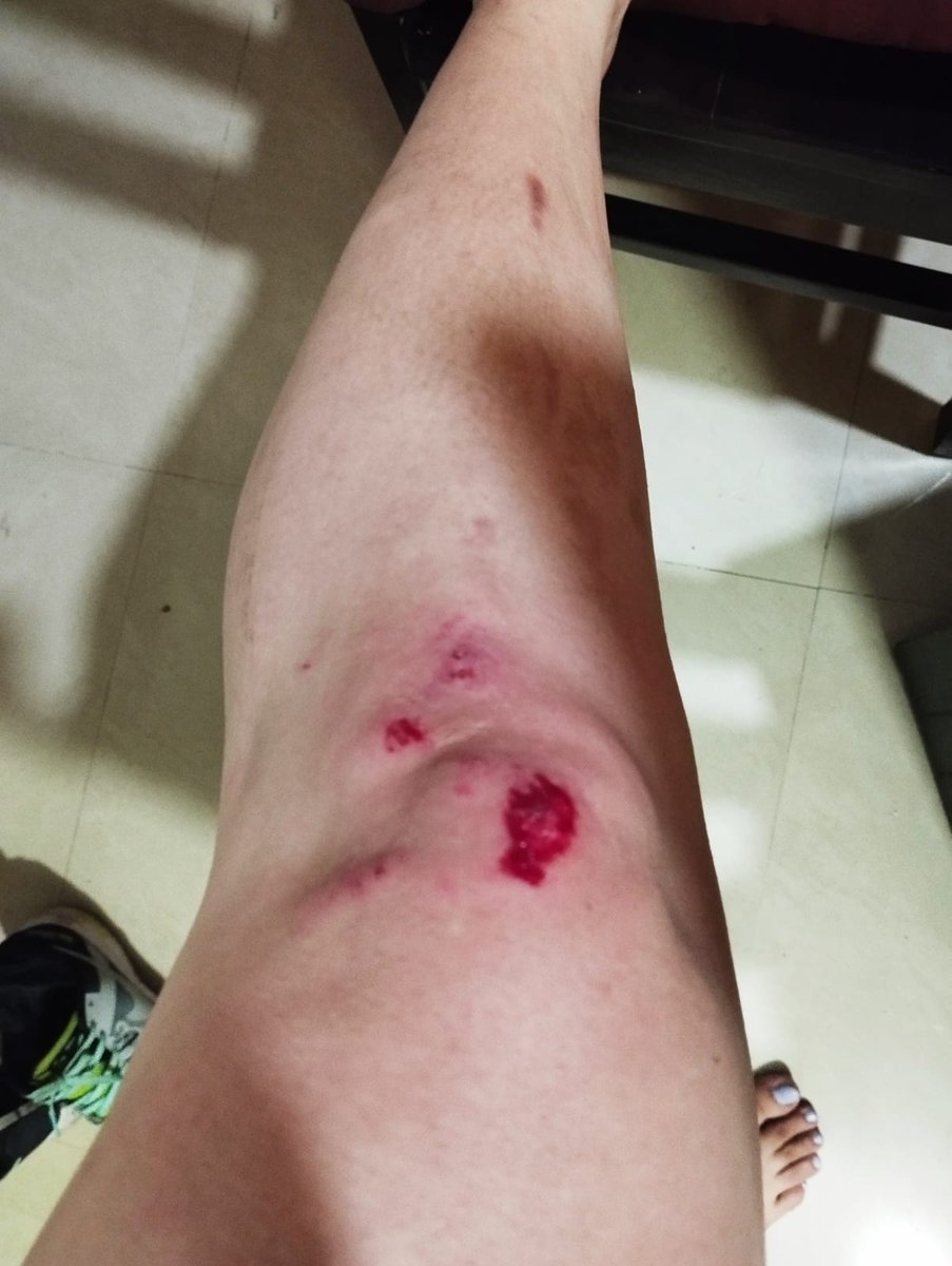 Rajiva2011's tweet photo. @noidapolice @noidatraffic @CeoNoida 
Lady cyclist injured today.Road opp Spectrum Mall,Metro station 52-50 Law &amp; order needs urgent review.Missing cycling tracks &amp; well lit roads makes riding unsafe.Women riders contant fear riding alone early morning hrs continues.@ChiefSecyUP https://t.co/29OUzKv0F2